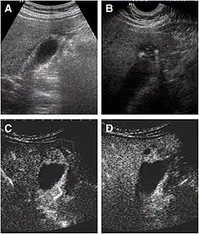 Non-contrast abdominal ultrasound and contrast-enhanced ultrasound (CEUS) of adenomyomatosis of the gallbladder: a The fundus of the gallbladder wall was thickened and the GB wall was obscure. b The intramural echogenic foci were detected by high frequency transducer. c CEUS—arterial phase (22 s) —heterogeneous hyper-enhancement and wall was intact. d CEUS—venous phase (34 s) the anechoic spaces were more clear.