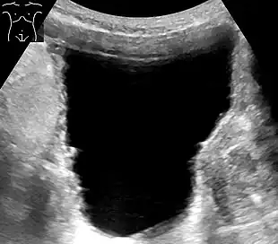 Ultrasonography showing a trabeculated wall, seen as small irregularities mainly at left (superior part). This is strongly associated with urinary retention.