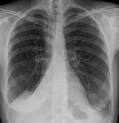 Atelectasis of the right lower lobe seen on chest X-ray.