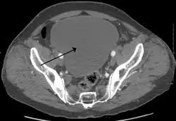 As seen on axial CT