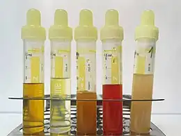 A variety of urine samples in a test tube rack. From left to right, the color and clarity of each  sample is: clear and dark yellow; clear and pale yellow; orange and cloudy; red and cloudy; pinkish-yellow and cloudy.