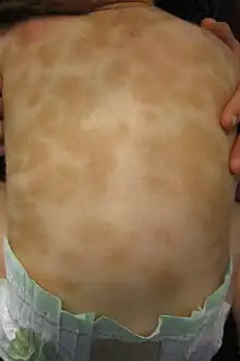The back of a child with urticaria pigmentosa