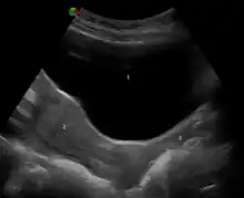 Ultrasonograph depicting urinary bladder at the top, above the uterus to its bottom-left and vagina to its bottom-right