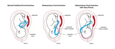 Velamentous Cord insertion