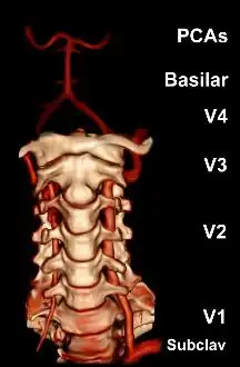 A reconstruction of the vertebral arteries from a CT scan, seen from the front. From the bottom, V1 is from the subclavian artery to the foramina, V2 is from the foramina to the second vertebra, V3 is between the foramina until entry into the skull, and V4 is inside the skull embedded in the dura mater. They merge into the basilar artery, which then divides into the posterior cerebral artery.