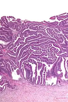 Micrograph of a villoglandular adenocarcinoma the cervix. H&E stain.