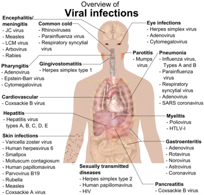 A photograph of the upper body of a man labelled with the names of viruses that infect the different parts