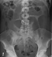 An x-ray of a person with a small bowel volvulus.