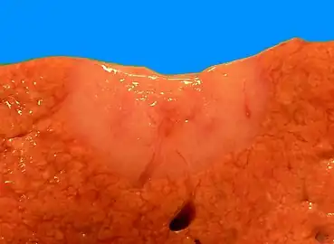 Gross pathologic appearance of a large bile duct hamartoma