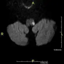 Clinical B1000 diffusion weighted MRI image showing an acute left sided dorsal lateral medullary infarct