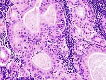 Histopathology of Warthin tumor in the parotid gland. H&E stain. (Fig 1)