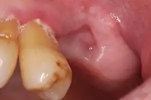 Well healed socket upper left molar 10 weeks after tooth removal.