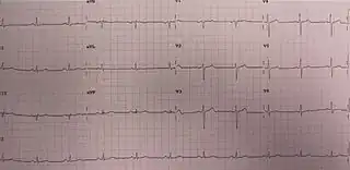 ECG in someone with Wellens' syndrome when having chest pain