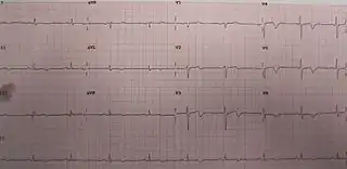 ECG of the same person when pain-free, note the biphasic T waves (type B) in leads V2 and V3