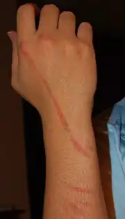 Photograph of an arm with four raised red lines