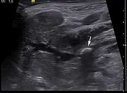 Ultrasound image of sialolithiasis