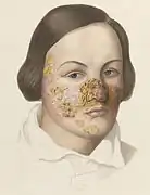 Illustration of a woman with a severe facial impetigo.