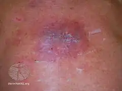 Wound infection -bacterial