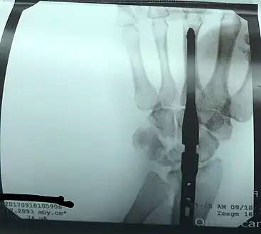X-ray on the right wrist showing arthrodesis.