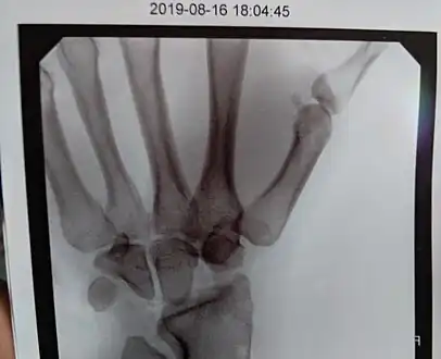 X-Ray on Left Hand Post-Proximal Row Carpectomy.