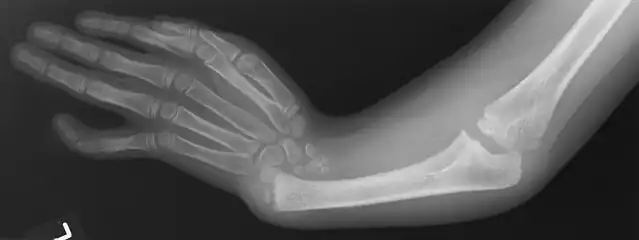 X-ray of arm showing absent radius and radially deviated hand, caused by Thrombocytopenia and Absent Radius syndrome