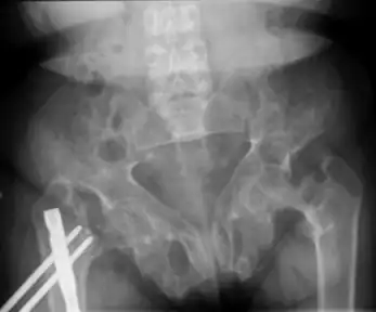 Brown tumors in the pelvis and a hip fracture.