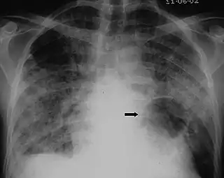X-ray of a cyst in pneumocystis pneumonia