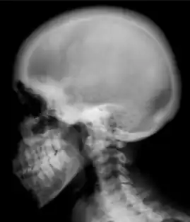 Ground glass density of the skull.