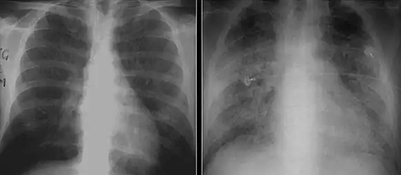 These chest radiographs are of two patients. Both show ground glass opacities. The left X-ray shows a much more subtle ground-glass appearance while the right X-ray shows a much more gross ground-glass appearance mimicking pulmonary edema.