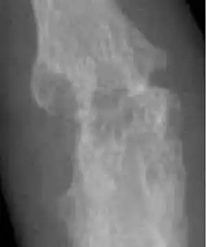Closeup of bone erosions in rheumatoid arthritis.