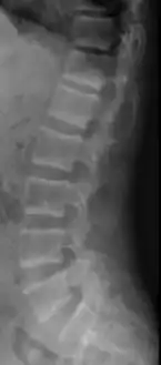 X-ray of a subtle "rugger jersey spine" due to sclerotic bands adjacent to the vertebral endplates.