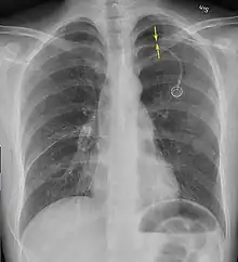 Anteroposterior inspired X-ray, showing subtle left-sided pneumothorax caused by port insertion