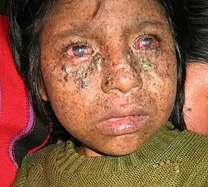 Frontal image of a child's face showing large hyperkeratotic papules and plaques with some induration suspicious for actinic keratoses and early squamous cell carcinomas