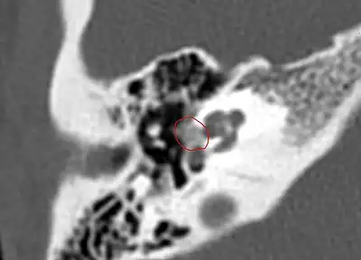 CT scan of otosclerotic focus in the anterior footplate