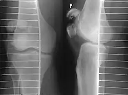 Comminuted fracture of patella