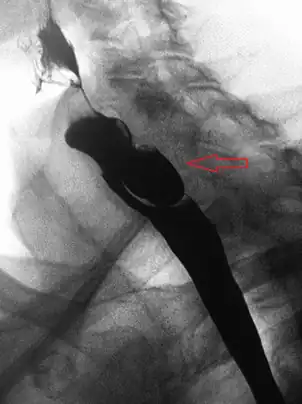 Lateral X-ray of a Zenker's diverticulum