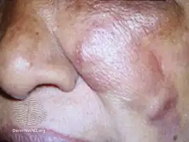 Mucormycosis skin near eyes and nose.