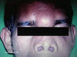 Mucormycosis skin of forehead.