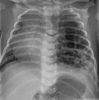 CPAM on chest radiograph in a newborn. Large cystic changes in the left lung, leading to a mediastinal shift to the right due to their mass effect.