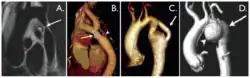 Aortic coarctation using different imaging techniques