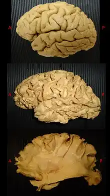 Stages of White matter dissection according to dissection technique