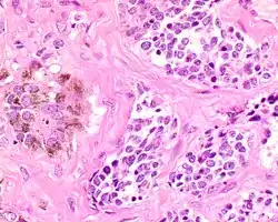 A high power of melanotic neuroectodermal tumor of infancy showing pigmented large epithelioid cells and smaller primitive cells in alveolar nests (hematoxylin and eosin stain).