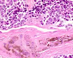 A high power of melanotic neuroectodermal tumor of infancy showing pigmented large epithelioid cells and smaller primitive cells (hematoxylin and eosin stain).