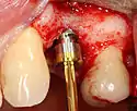 A healing abutment is attached to the implant fixture and the gingiva flap is sutured around the healing abutment.