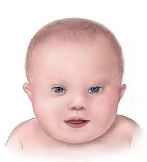 Illustration of the facial features of Down syndrome