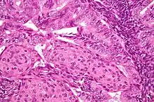 Image of the histology of an endometrioid endometrial adenocarcinoma