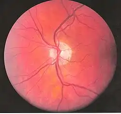 Left eye blood vessels