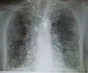 A chest X-ray demonstrating pulmonary fibrosis.  By history, the pulmonary fibrosis is thought to be due to amiodarone.