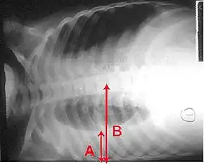 An X-ray showing a chest lying horizontal. The lower black area, which is the right lung, is smaller with a whiter area below it of a pulmonary effusion. There are red arrows marking the size of these.