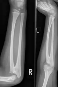 Plain radiograph showing fusion of the radius and ulna